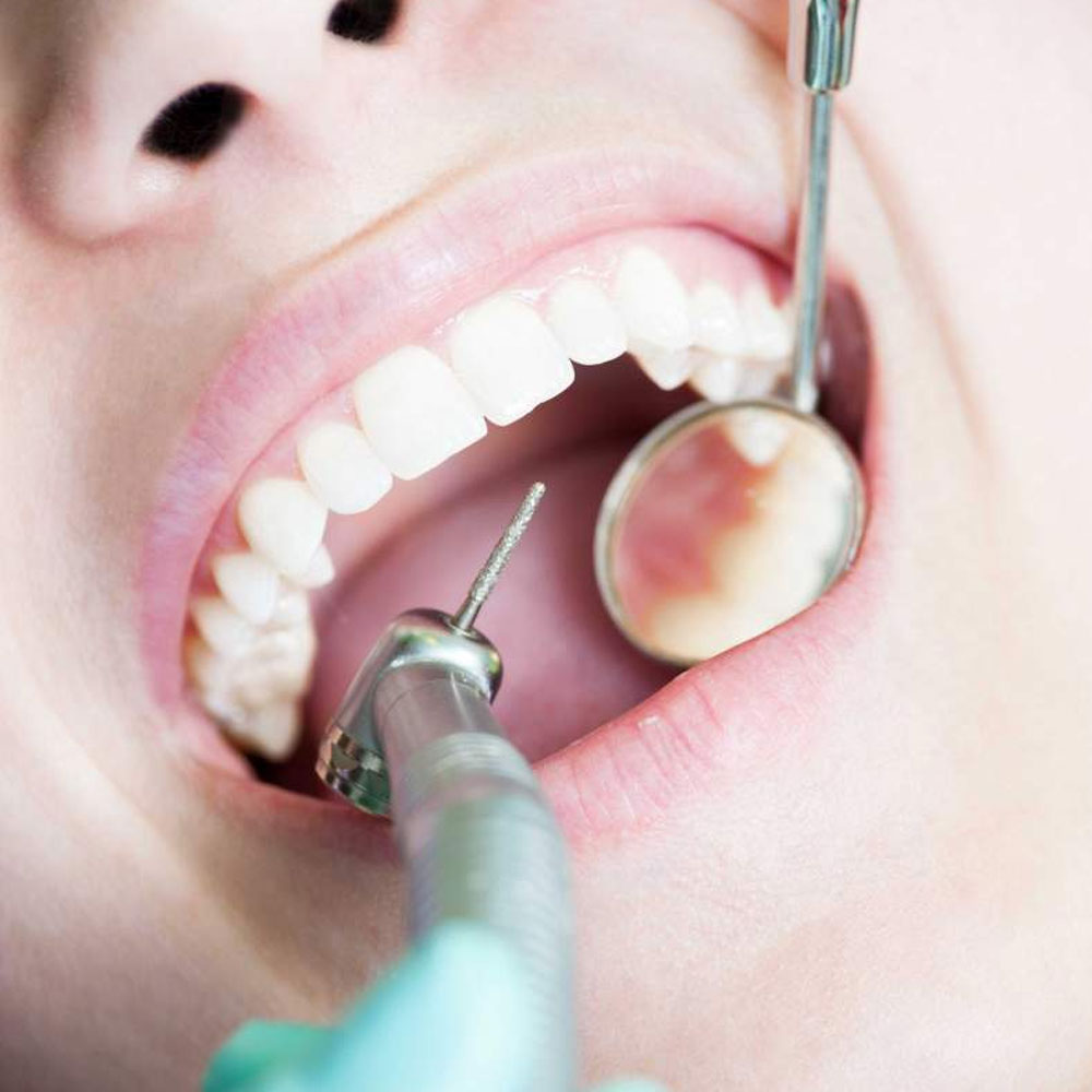 White Teeth Fillings