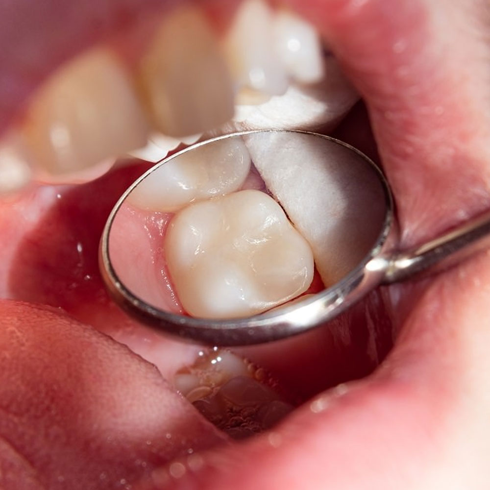 White Teeth Fillings